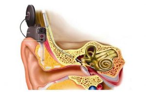 Read more about the article Is it risky for children to have cochlear surgery?