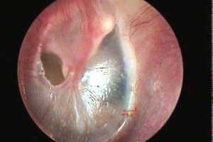 Read more about the article Does the tympanic membrane perforation affect our hearing?