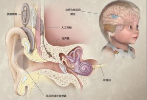 Read more about the article The difference between hearing aids and cochlear implants