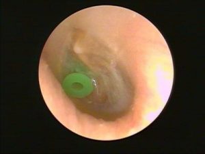 Read more about the article If you have otitis media, will you pour water?
