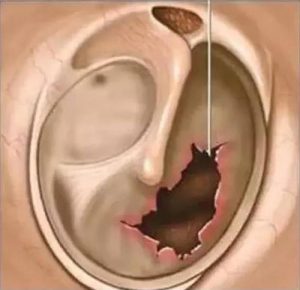 Read more about the article Can the tympanic membrane be worn with a hearing aid?