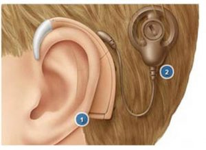 Read more about the article Hearing loss patients with hearing aids or cochlear implants
