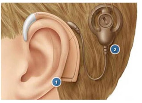 Hearing aids and cochlear implants