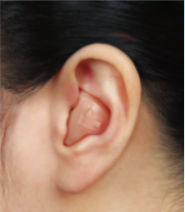 Read more about the article How to choose a custom hearing aid