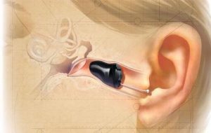 Read more about the article Advantages and disadvantages of fully concealed hearing aids